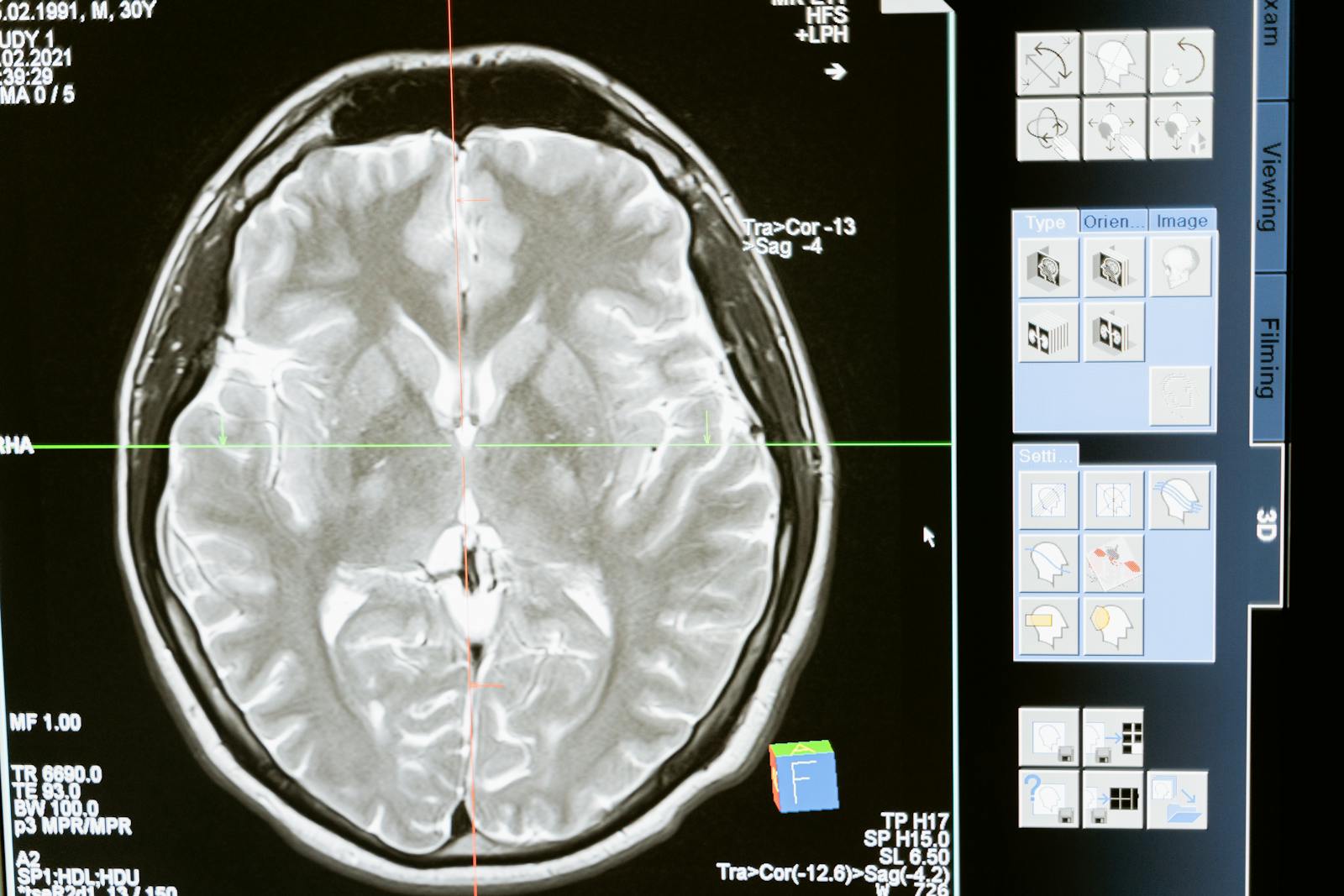 Brain MRI scan on a screen